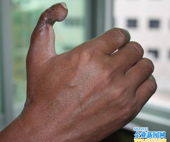 高清组图：农民工医院就医 手掌被接上脚趾头
